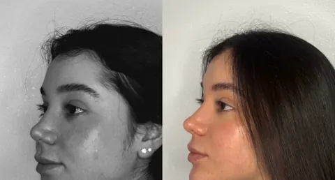 Antes e depois do perfil de uma paciente