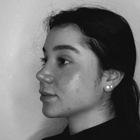 Antes: perfil da paciente sem harmonização