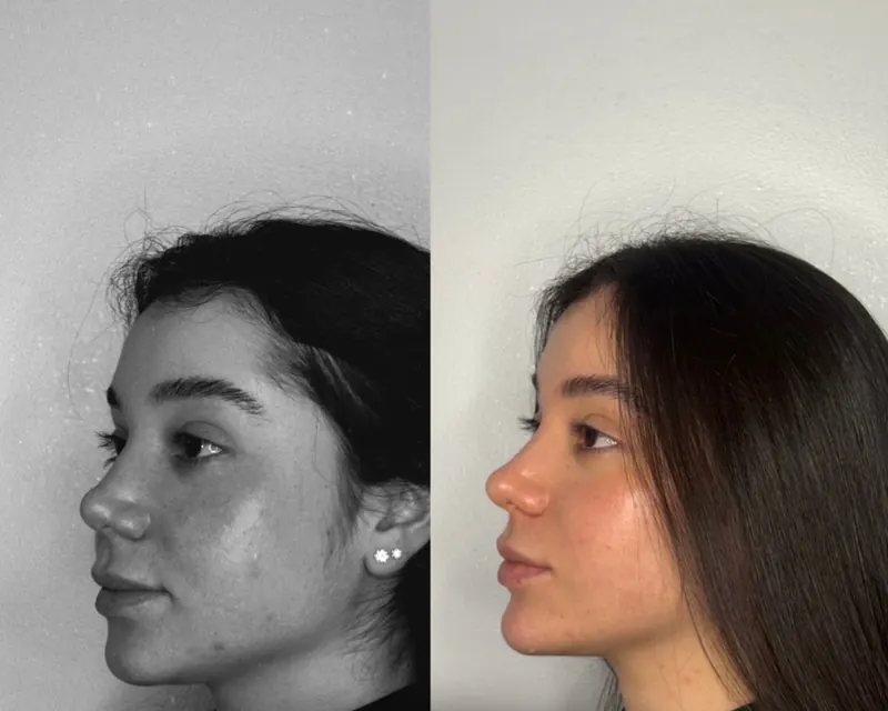 Perfil de uma paciente antes, em preto e branco, e depois da harmonização